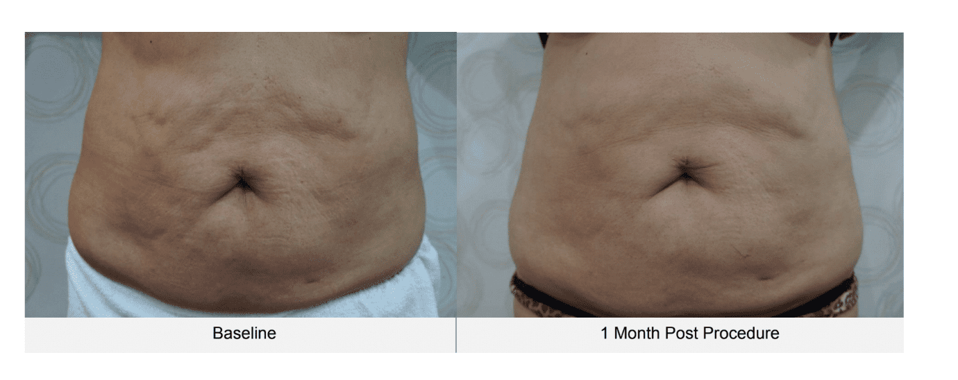 Ultraformer 3 skin tightening Harely Street - London Demasurge Clinic