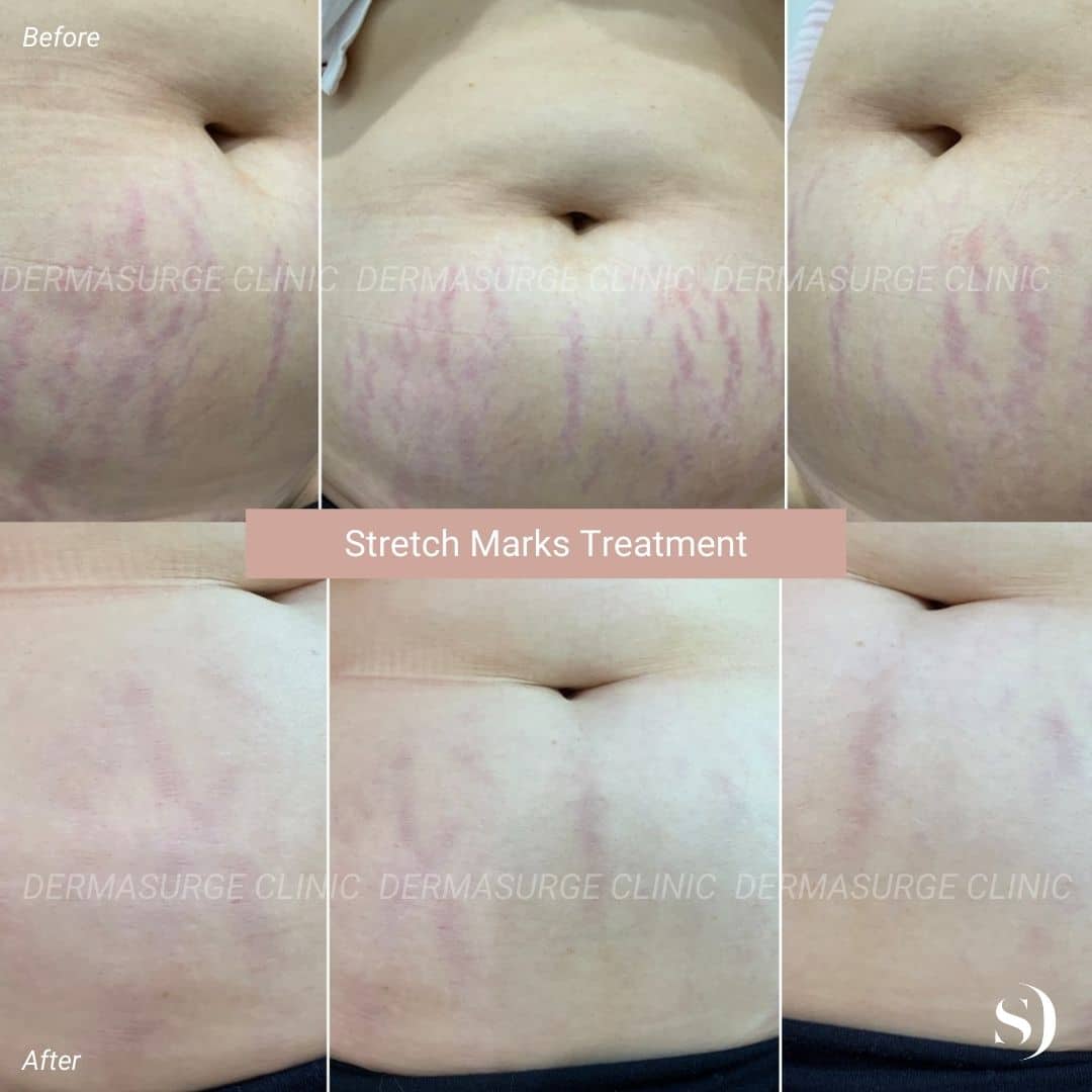 Stretch Marks Treatment - The Center for Women's Aesthetics